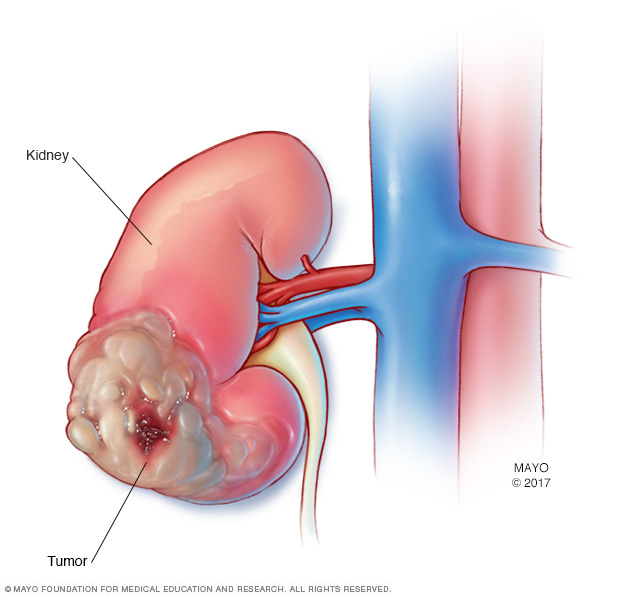 Kidney cancer - Mayo Clinic renal cyst diagram 